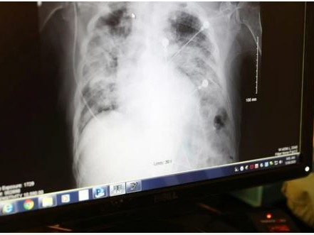 Mỹ: Tử vong sau khi được ghép phổi của người nhiễm... virus SARS-CoV-2