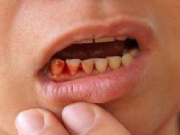 3 dấu hiệu ở răng chứng tỏ gan đang 'kêu cứu': Hãy tự kiểm tra xem bạn có không?