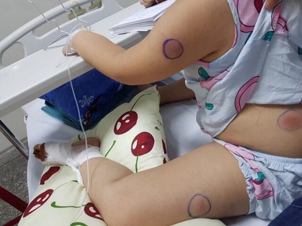 Gà mổ vào chân, bé gái bị nhiễm khuẩn 'ăn thịt người'