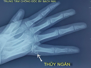 Vẩy nhiệt kế, bé gái nhiễm độc thủy ngân