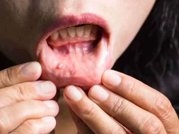 Một người có ung thư miệng sắp di căn sẽ xuất hiện 2 dấu hiệu nhỏ này, bạn phát hiện sớm sẽ kéo dài được thời gian sống