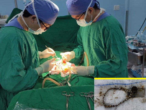 Cứu sống bé trai nuốt chuỗi hạt kim loại và nam châm