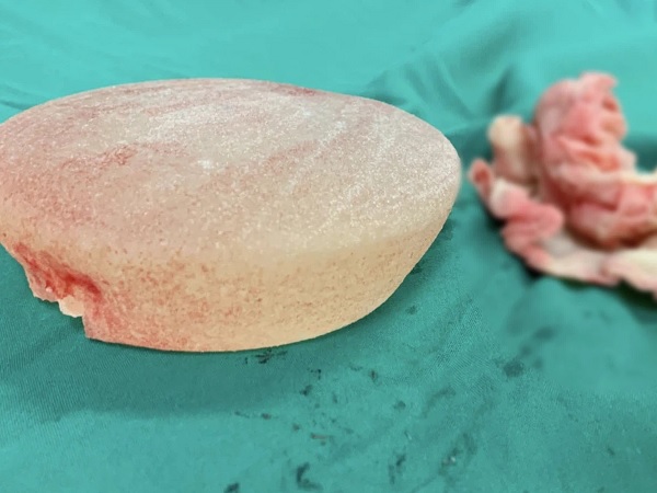 Kinh hoàng: Nữ bệnh nhân bị spa bỏ quên miếng gạc trong ngực suốt 1 tháng khiến ngực lở loét chảy dịch khủng khiếp