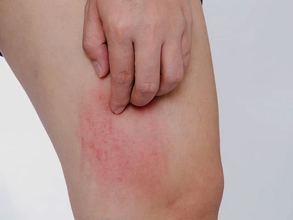 Cô gái 32 tuổi đột nhiên bị mẩn ngứa khắp người, đi khám mới biết đã mắc ung thư gan