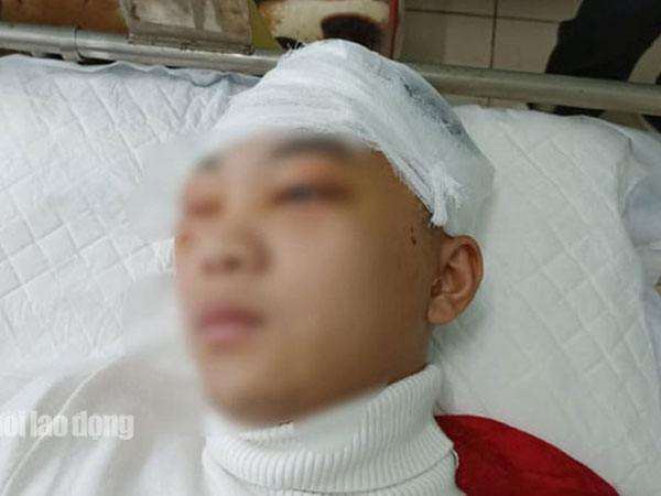 Nam sinh lớp 11 bị bạn đánh vỡ sọ não tổn hại sức khỏe tới 49%