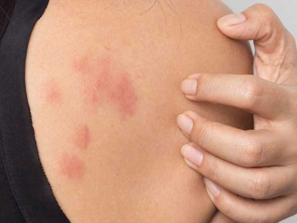 Bốn triệu chứng trên da ít người biết đến của bệnh nhân Covid-19