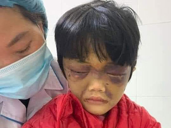Bà mẹ ở Cẩm Giàng đánh đập con gái 6 tuổi thâm tím mặt