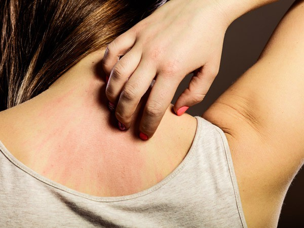 Vì sao nhiều người dễ bị mẩn ngứa vào mùa hè?
