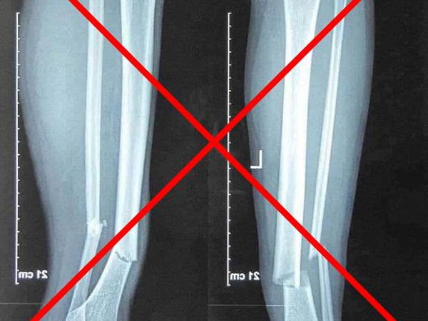 Hình chụp X-quang gãy rời 2 chân của Hùng Dũng gây sốc trên MXH là giả, đây mới là ảnh thật