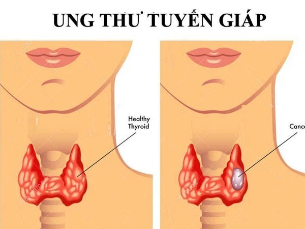Càng nhiều người trẻ mắc ung thư tuyến giáp, bác sĩ Bệnh viện K khuyến cáo: 'Khi sờ hoặc nhìn thấy khối u xuất hiện vùng cổ, nên đi khám ngay'