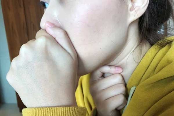 Sốt kéo dài 2 tuần, cô gái 20 tuổi được chẩn đoán suy tim, suy gan, có nguy cơ đột tử