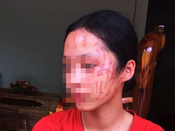 Rùng mình hình ảnh nữ sinh lớp 8 bị 'đàn chị' cào nát mặt: Hé lộ nguyên nhân