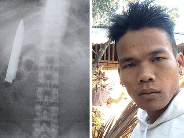 Bị găm lưỡi dao trong người hơn một năm mà không biết