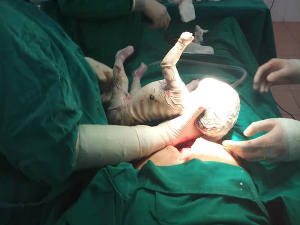 Xót xa bé trai chào đời bị da vảy cá, toàn thân bao phủ vảy trắng với nhiều vết rạn chảy máu