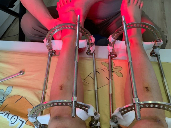 Cô gái Hà Nội giấu bố mẹ đi kéo chân: Không mua quần áo suốt nhiều năm để tiết kiệm, leo lên bàn mổ với ước mơ cao thêm 7cm