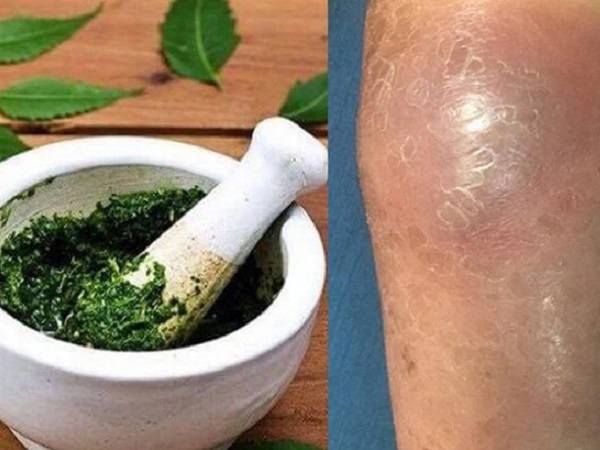 SOS: Suy đa phủ tạng, suýt mất mạng vì chữa nhọt bằng đắp lá