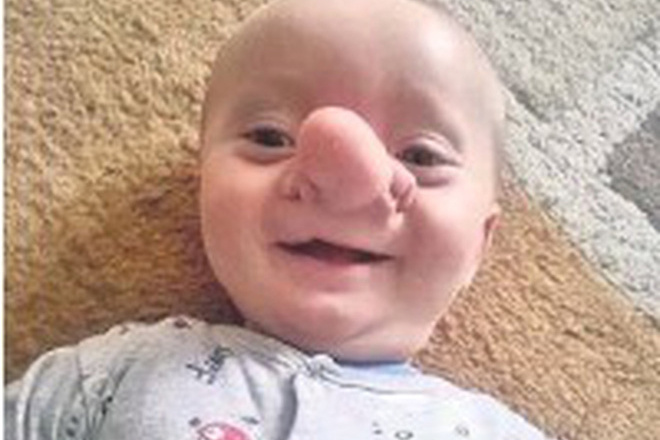 'Cậu bé Pinocchio đời thực' sinh ra với chiếc mũi to dị dạng khiến bố mẹ cũng sốc, gây bất ngờ với diện mạo sau ít năm