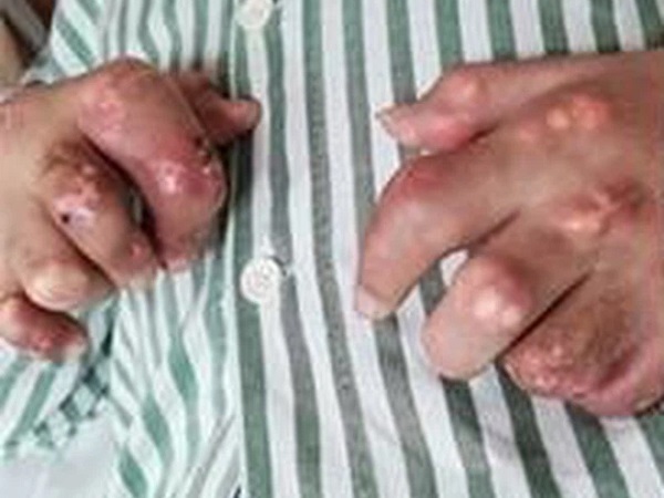 Chàng trai 27 tuổi bị thối chân, biến dạng khớp, bàn tay phủ đầy hạt tophi vì loại nước uống yêu thích của nhiều người