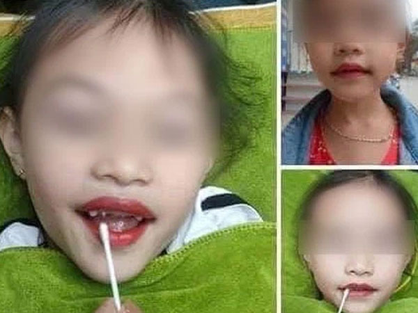 Từ chuyện bé 5 tuổi phun môi collagen: Phun xăm môi cho trẻ em dẫn đến những hệ lụy gì?