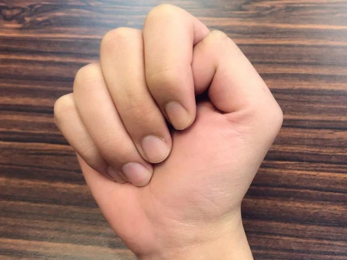 Đây là 3 cách kiểm tra cực nhanh giúp bạn biết được mình có nguy cơ bị tắc nghẽn mạch máu hay không?