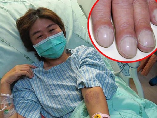 Bị ung thư phổi, cô gái khóc nấc khi lỡ chủ quan bỏ qua dấu hiệu nguy hiểm này ở ngón tay