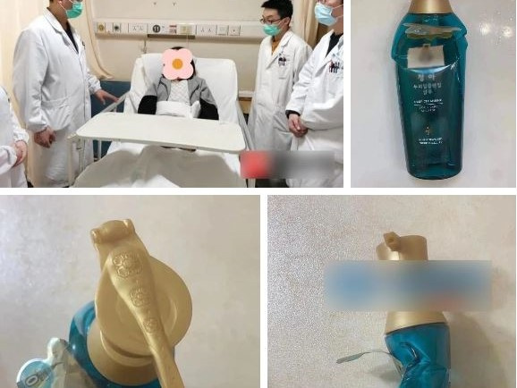 Trượt ngã trong nhà tắm bị chai dầu gội đầu cắm vào mông, cô gái trẻ cố rút ra rồi... nhập viện do rách hậu môn