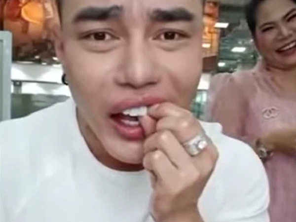 Lê Dương Bảo Lâm gặp sự cố khi livestream: Ăn gà bị mẻ răng sứ, phải mượn keo gắn
