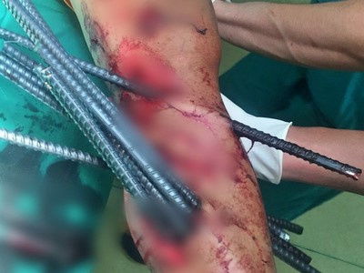Kinh hoàng: Va chạm với xe ba gác, nam thanh niên bị 11 thanh sắt dài đâm xuyên chân