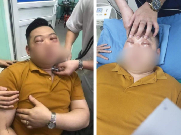 Thái 1 củ hành, thanh niên 25 tuổi bị sốc phản vệ nặng phải vào viện cấp cứu