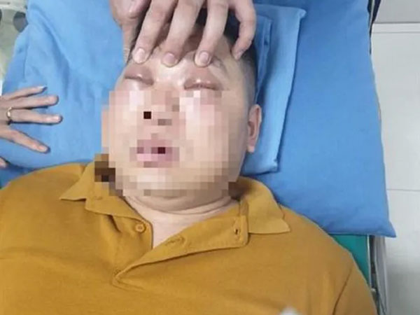 Sốc phản vệ vì thái một củ hành: Nỗi ám ảnh khác