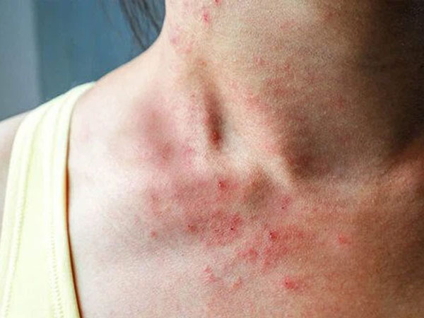 Tự kiểm tra ung thư gan bằng việc soi gương mỗi ngày: Nếu phát hiện 3 bất thường này trên da thì khả năng cao bạn đã mắc bệnh