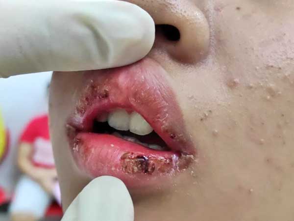 Mua son quảng cáo trên facebook giá 5.000 đồng/hộp về dùng, thiếu nữ 15 tuổi sưng vù môi và đóng vảy khô đen