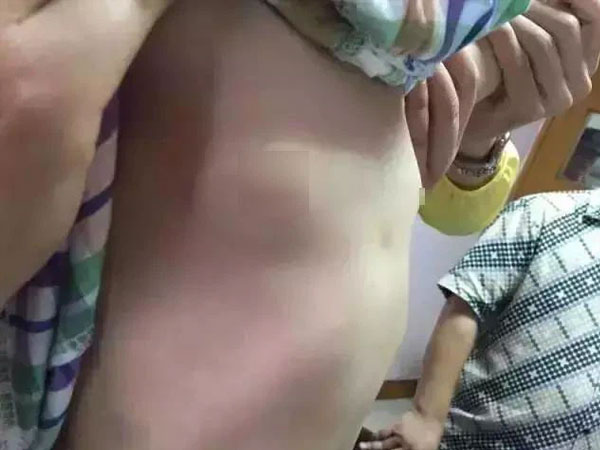 Bé gái 6 tuổi có cục u ở ngực do dậy thì sớm, nguyên nhân xuất phát từ món trứng rất quen thuộc