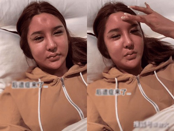 Hot girl nổi tiếng công khai ảnh phẫu thuật hỏng lõm cả trán, khuôn mặt biến dạng