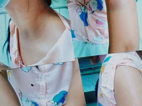Nghi vợ gọi điện cho bạn gái mình, chồng dùng thắt lưng quật vợ nhập viện, ho ra máu, đánh con ruột sưng trán