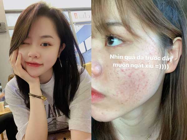Bồ cũ Quang Hải công khai ảnh da đầy mụn trước đây, netizen sửng sốt vì thay đổi ngỡ ngàng