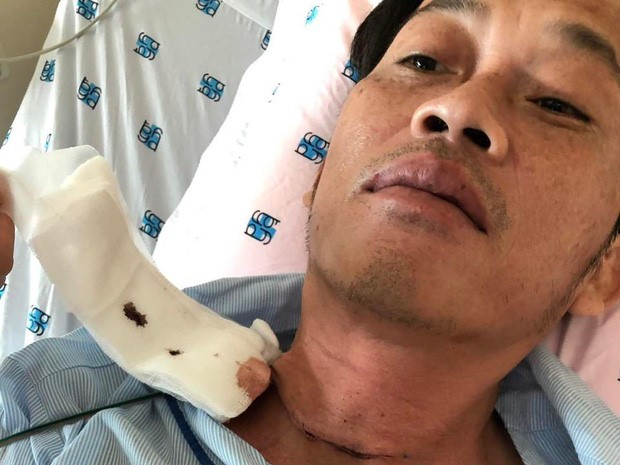 NÓNG: Nghệ sĩ Hoài Linh phẫu thuật vì bị u ác tuyến giáp cách đây vài tháng