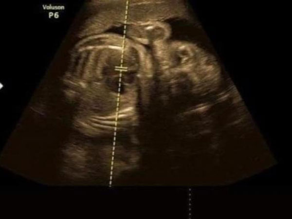 Bầu to 7 tháng còn bê chậu quần áo to vật lên tầng phơi, cô vợ trẻ bị ngã khiến con không có tim thai, nguyên nhân đằng sau khiến dân tình phẫn nộ