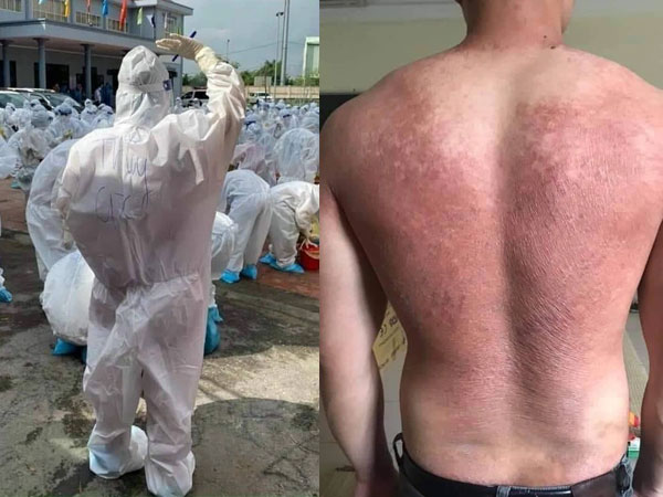 Hình ảnh bác sĩ nơi tâm dịch Bắc Giang khiến nhiều người xót xa: Phía sau lớp áo bảo hộ là tấm lưng cháy nắng phồng rộp