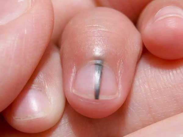 3 bộ phận này chuyển sang màu đen nghĩa là tế bào ung thư đang phát triển trong cơ thể