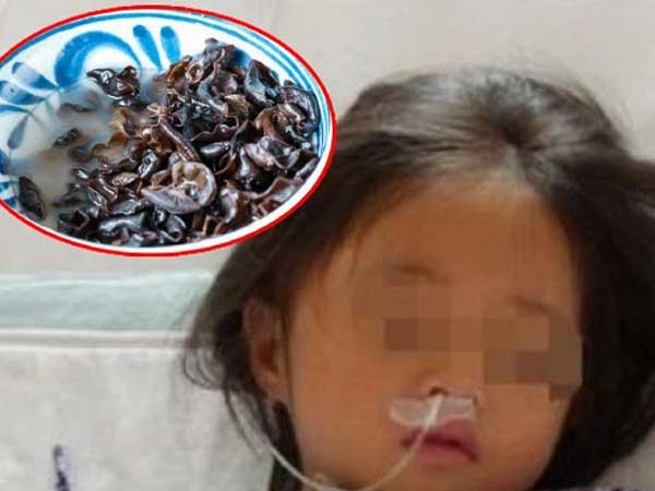 Bé gái 7 tuổi bị suy đa tạng vì bố mẹ phạm sai lầm khi chế biến loại nấm nhiều người yêu thích
