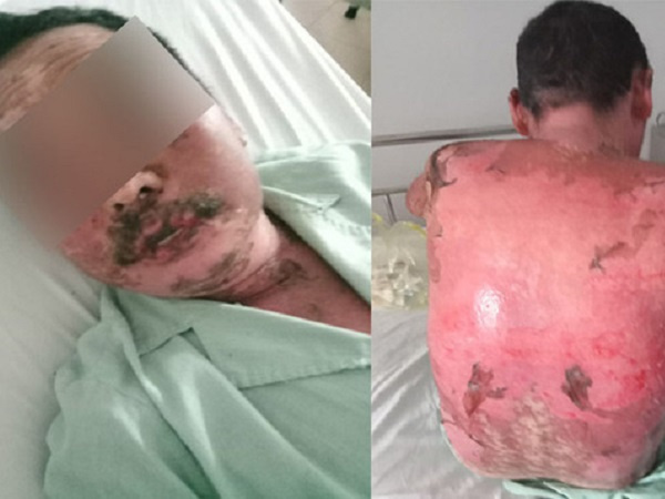 Dị ứng thuốc trị gout, người đàn ông bong tróc da toàn thân
