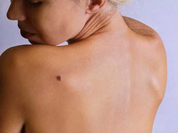 Chuyên gia hướng dẫn các bước kiểm tra da để phát hiện ung thư sớm