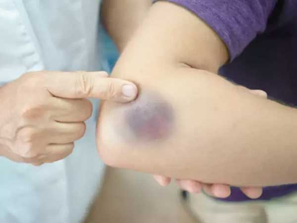 Vết bầm tím trên cơ thể, tưởng đơn giản nhưng có thể là dấu hiệu cảnh báo bệnh lý nguy hiểm
