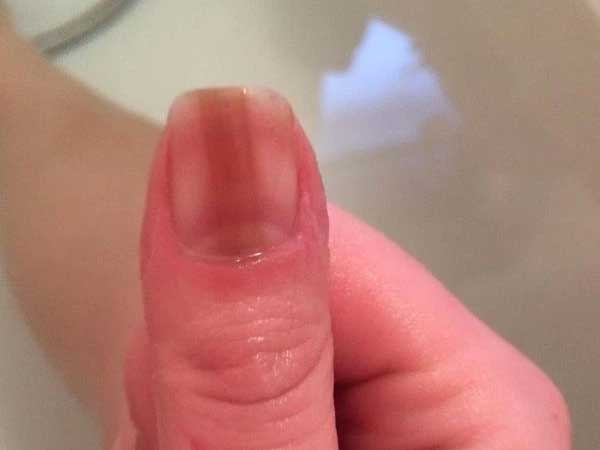 Sơn màu đỏ để che đi móng tay xấu xí, người phụ nữ không ngờ đó là dấu hiệu ung thư: Nếu có 3 biểu hiện này ở tay, cần đi khám ngay