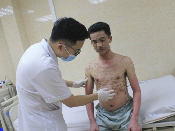 Người đàn ông Hà Nội cả người chuyển màu nâu, đau đớn như kim châm vì căn bệnh 'lạ'
