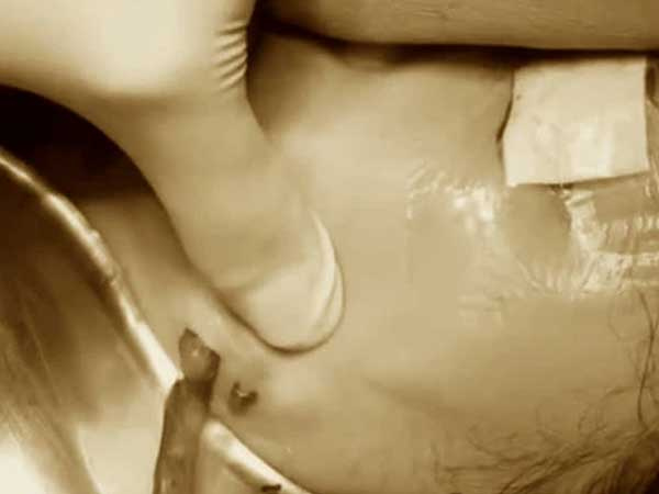 Cô gái 24 tuổi bị nhiễm trùng vùng mặt nghiêm trọng sau 3 năm tiêm filler