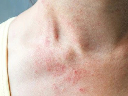 4 biểu hiện bất thường trên da là dấu hiệu sớm của bệnh ung thư gan, cần chủ động đi khám ngay khi gặp phải