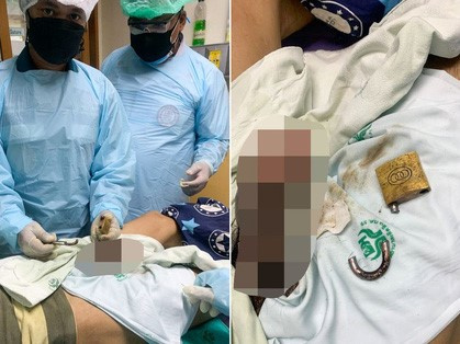 Đeo khóa vào vùng kín để 'đổi gió' rồi làm mất chìa, người đàn ông biến dạng của quý vĩnh viễn sau 2 tuần mắc kẹt