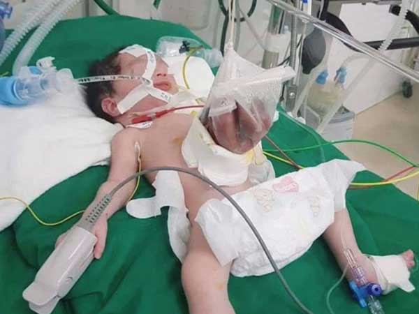 Bé sơ sinh 2kg có nội tạng nằm ngoài ổ bụng, bác sĩ đã làm được điều kì tích sau 2 lần phẫu thuật